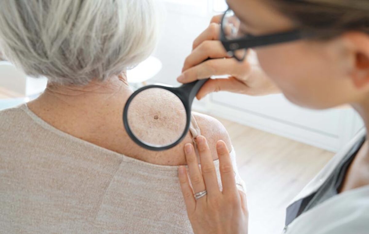 Kdaj k dermatologu na pregled znamenj?